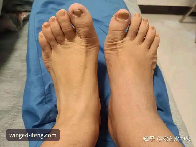 凤凰体育客户端下载对比 世界杯梦想vs身体极限:瑞典中场贝里瓦尔手术康复之路的对比抉择